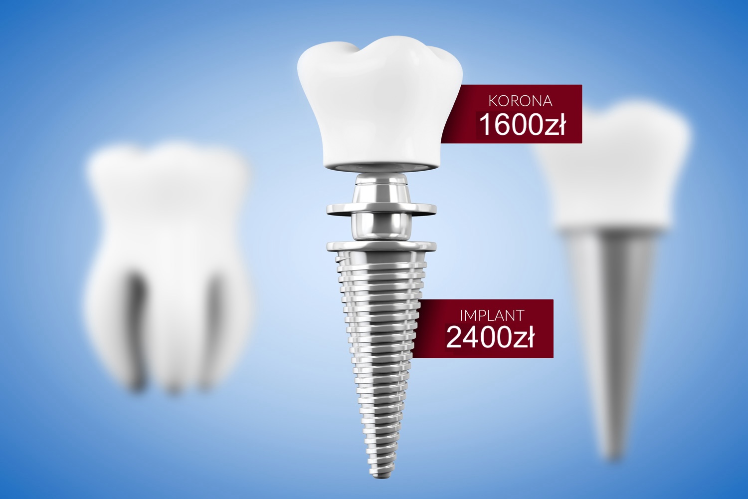 Stomatology concept. Tooth Implant with Tooth